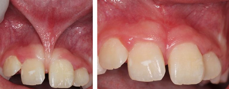 Frenectomy - Wyndham Periodontist